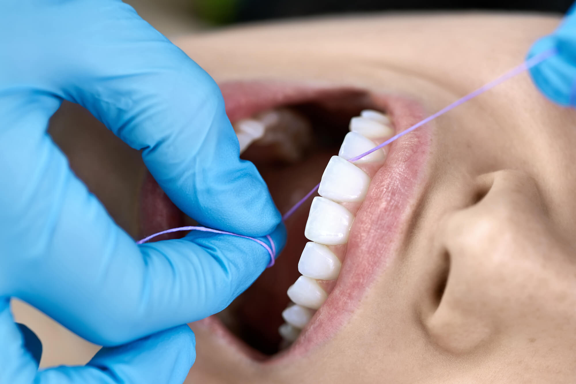 woman in dental office undergoing Teeth Cleanings in Seneca
