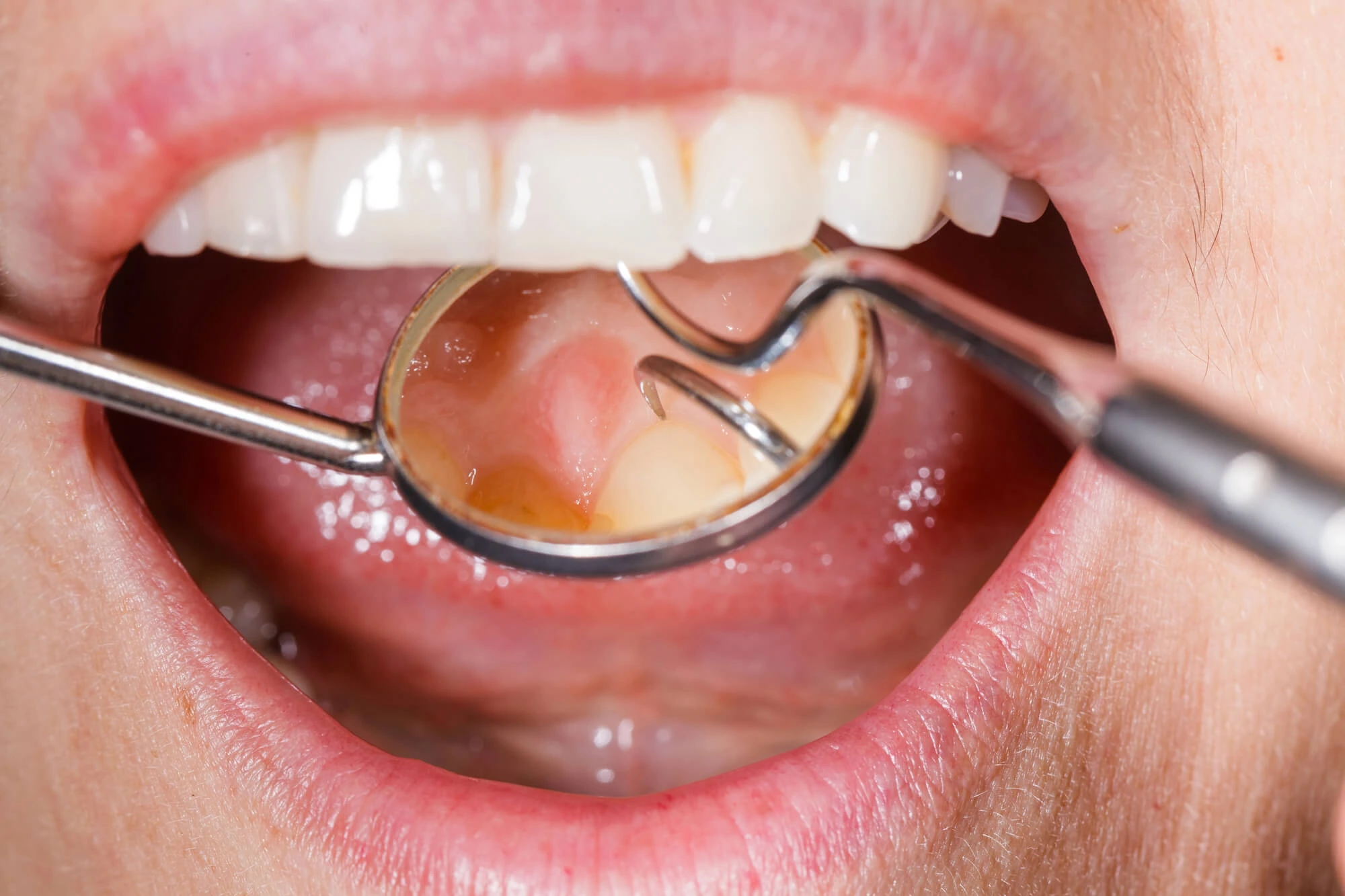 Oral Cancer Screenings in Seneca