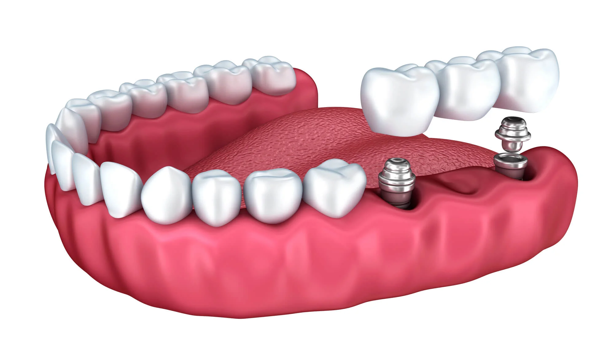 Smiling woman after dental crown treatment, Crowns in Seneca