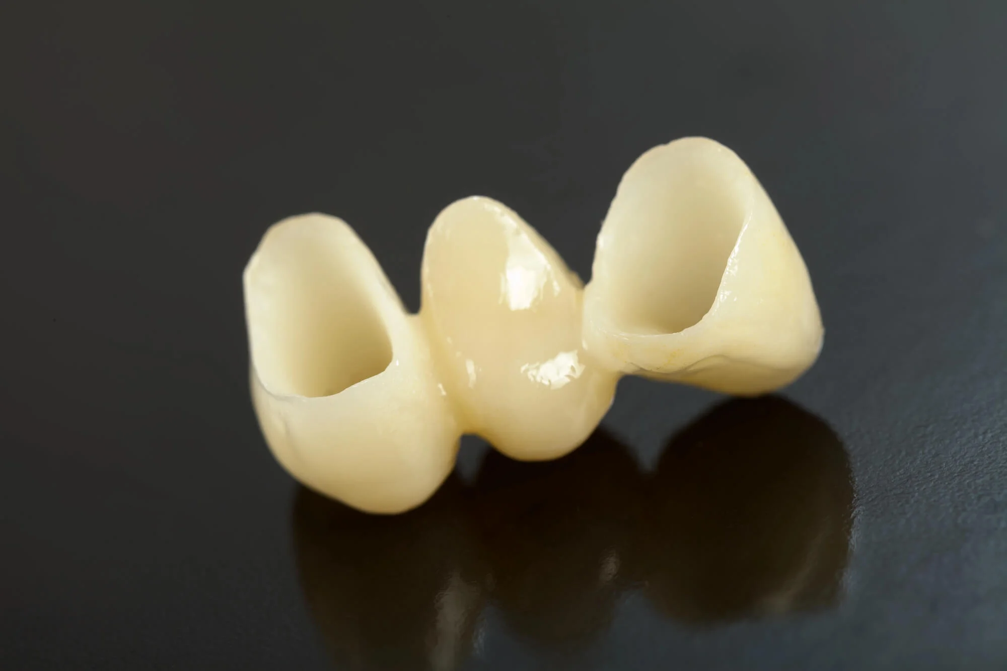 What Happens When You Replace Missing Teeth With a Dental Bridge?