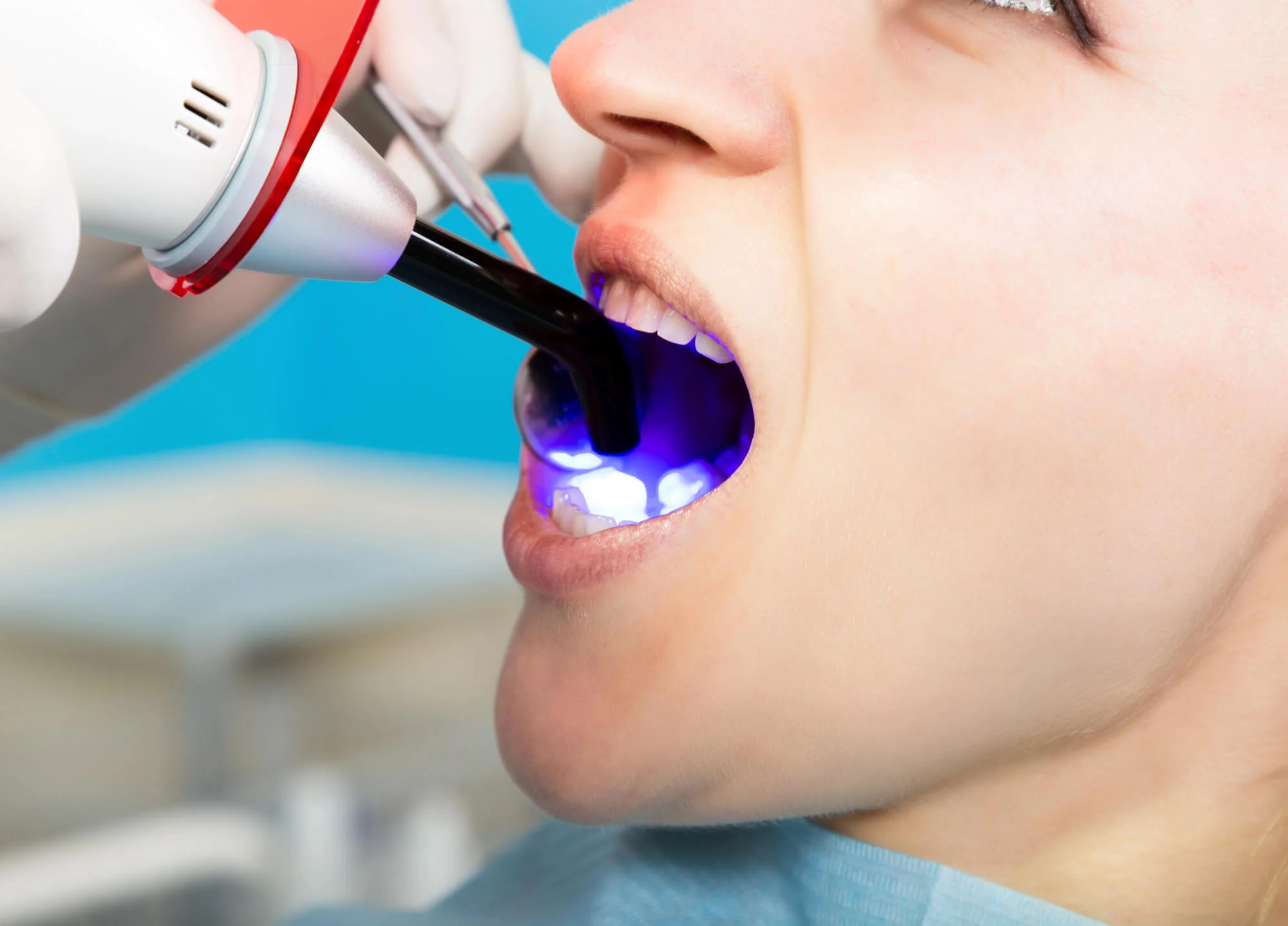 Tooth-colored filling cured with dental light