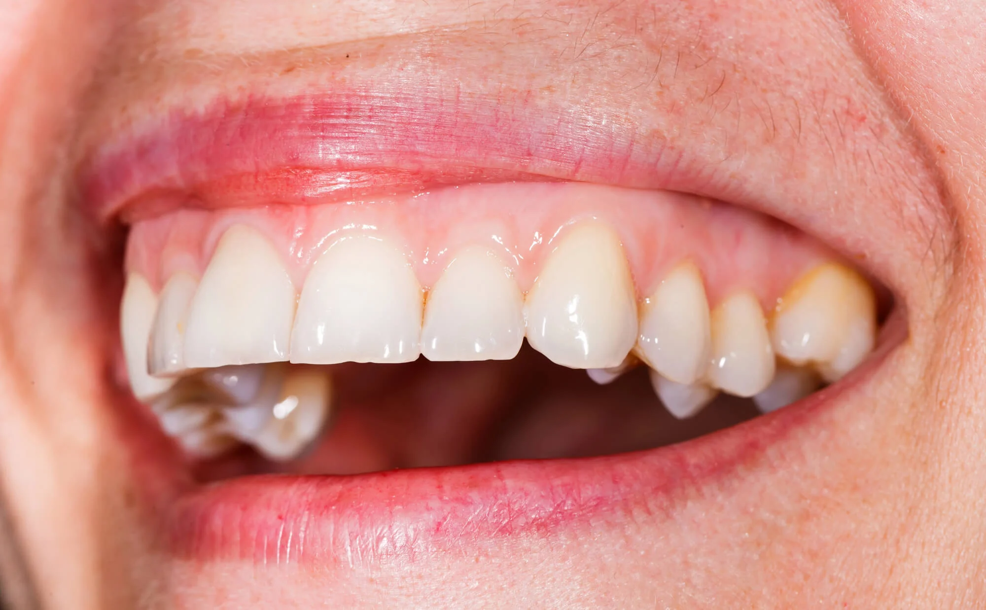 Close-up-of-gum-recession-needing-Dentures-29678