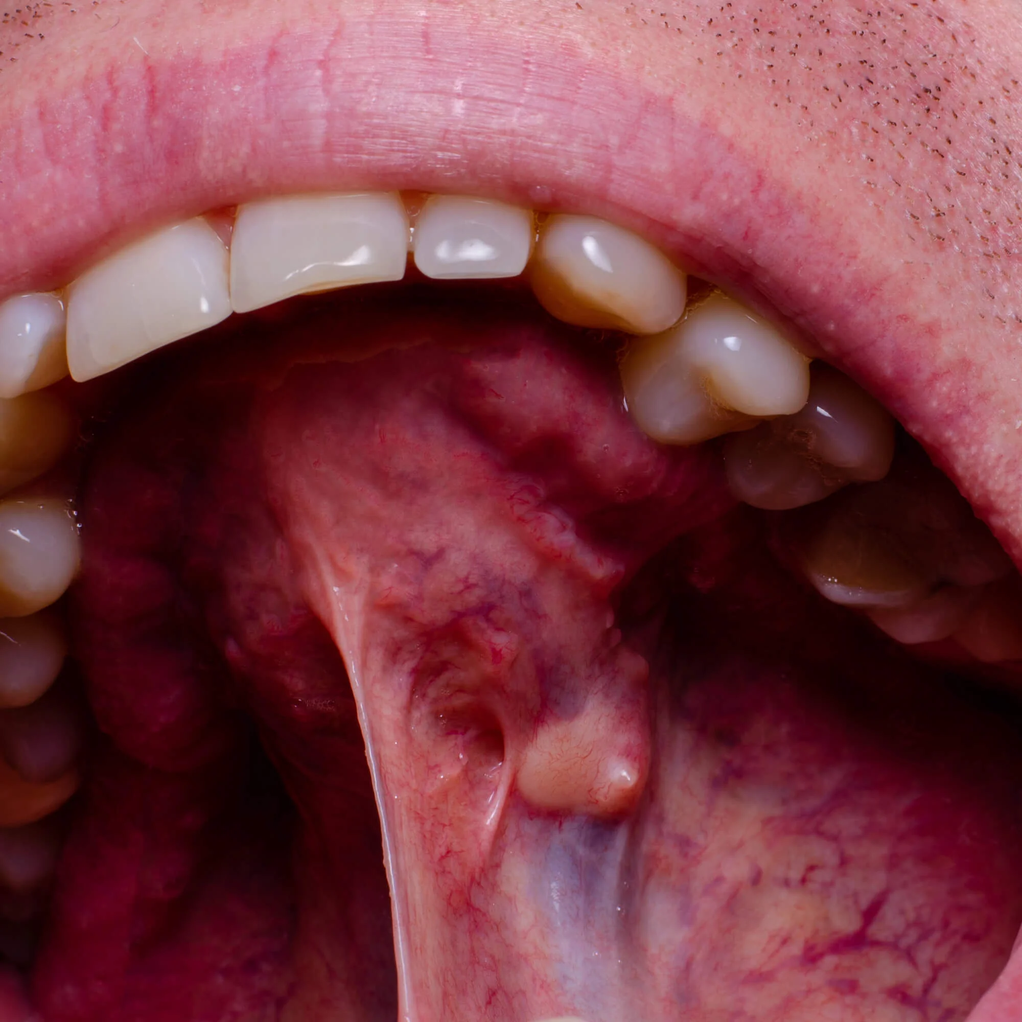 Dentist checking changes inside the mouth, Oral Cancer Screenings in Seneca